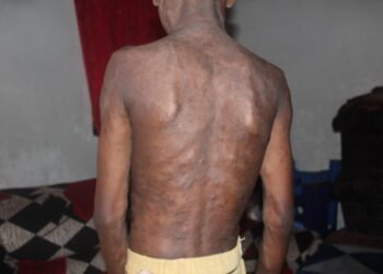 SOS : victime d&rsquo;une maladie de déformation, Mamadou Yaya Camara risque de perdre ses membres si rien n’est fait