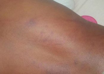 Labé : une fillette de 11 ans victime de violences corporelles pour un vol présumé de 100 000 GNF
